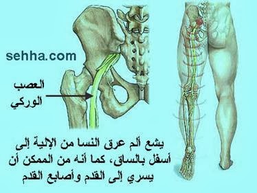 ما علاج عرق النسا 20160704 106