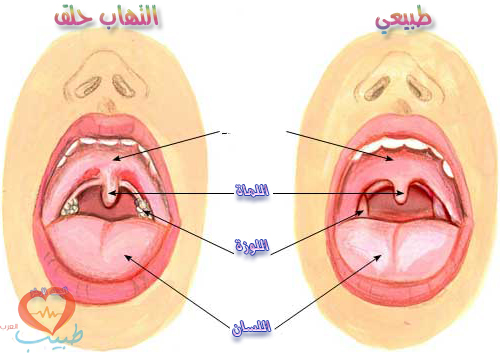 الحرقان في الحلق اسبابه وعلاجه 20160619 571