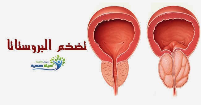 مرض تضخم البروستاتا وعلاجها - للرجال فقط لا تخف لها حلول سريعة 20160701 2172