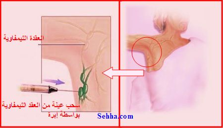 الم في الابط الايسر 20160711 17