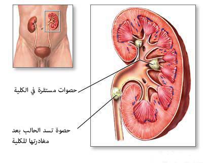 اين يقع الم الكلى 20160719 2044