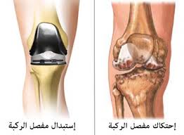 افضل علاج لخشونة المفاصل - علاج خشونة المفاصل نهائيا 20160708 373