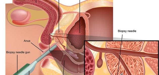 اسباب تضخم البروستاتا وعلاجه - سبب عدم القدرة على تبول عند الرجال 20160628 2004