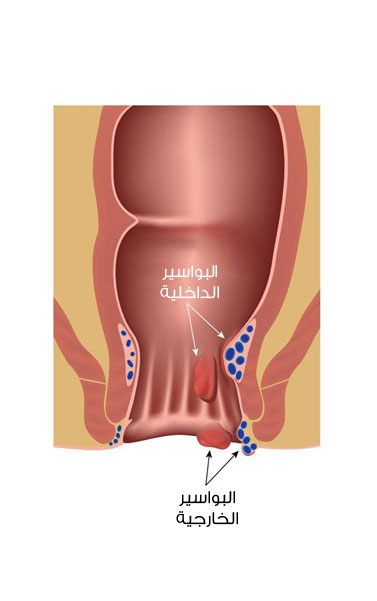 افضل مسكن لمرض البواسير 20160711 314