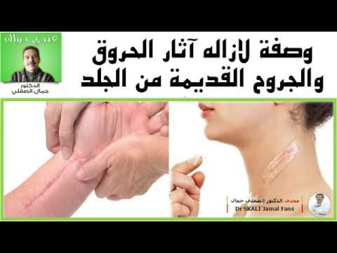 خلطات ووصفات لازالة اثار الحروق - وصفة لازالة الحروق البسيطة 20160716 1090