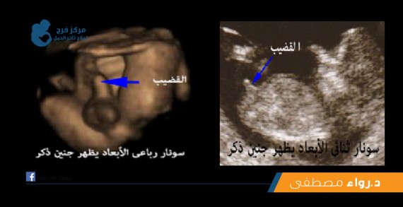 كيف يتم معرفة نوع الجنين بالسونار 20160718 372