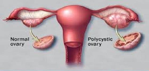 علاج كيس في المبيض - معلومات كامله عن تكيس المبيض وعلاجه 20160718 5062