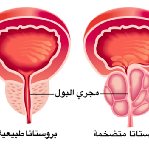 مرض تضخم البروستاتا وعلاجها - للرجال فقط لا تخف لها حلول سريعة 20160701 2173