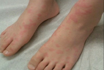 هل مرض الارتيكاريا معدي Urticaria4F98Ea3E 7F8C 4B36 8Abd D426E7367A45