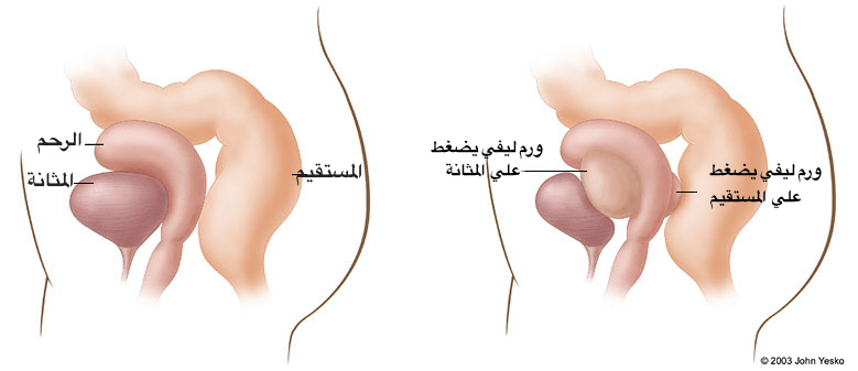 الاورام الليفية في الرحم والحمل 20160718 120