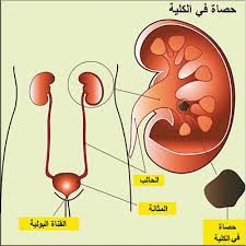 كيف اتخلص من رمل الكلى - الاسباب الشائعة لتلف الكلى 20160724 5