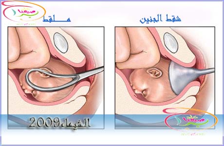 مشكله ضيق الحوض والولادة - الولادة صعبة اوي 20160705 369