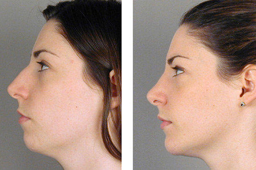 كيفية تصغير حجم الانف - هتخلي أنفك نونو وتبقي موزه Silastic Chin Implant After