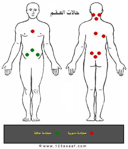 الحجامة والعقم عند الرجال - علاج فعال للخلفة عند الرجل 20160703 87