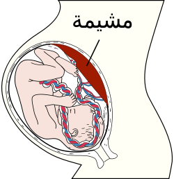 تكلس المشيمة واسبابه والعلاج 20160718 32