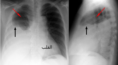 اسباب الماء على الرئة 20160714 2437