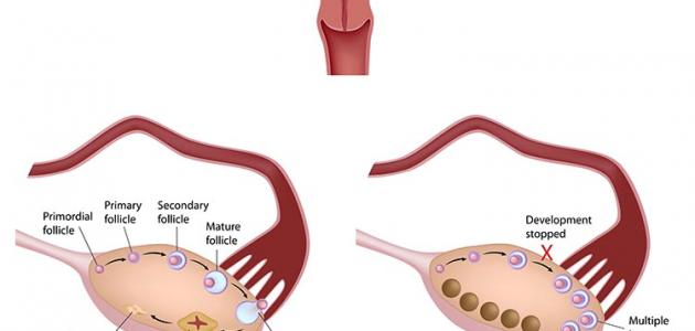 معلومات عن حويصلات المبيض - معلومات علي المدى البعيد عن حويصلات المبيض 20160623 1373