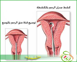 عملية توسيع عنق الرحم - وداعا لاسباب تاخير الحمل 20160707 2