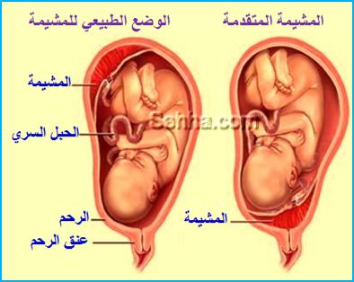 مشكله هبوط المشيمة وحلها - كل ما تريدين معرفته لعلاج والوقايه من نزول المشيمه 20160714 2124