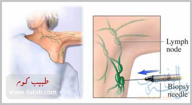 علاج التهاب الغدد اللمفاوية تحت الابط