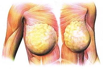 وخطر هي ما للجسم على صحة الزايده الدوده التهابها الإنسان أهميتها Breast