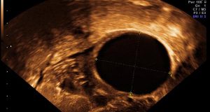 ماء كيس في الرحم الحمل اثناء follicle cyst 300x160