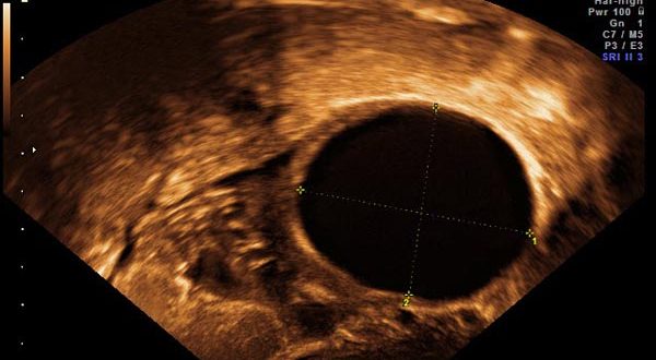 ماء كيس في الرحم الحمل اثناء follicle cyst 600x330